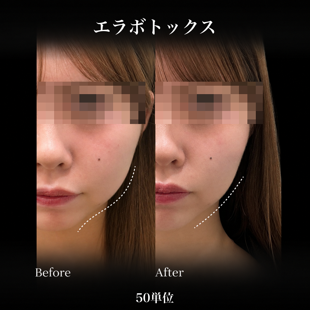 来院診療｜ボツラックス10U/50U/100U/200U【Elifa Clinic】