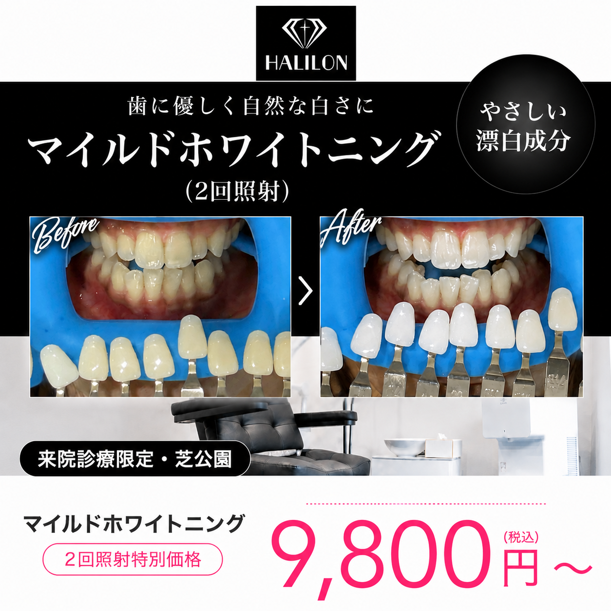 来院診療｜マイルドホワイトニングプラン(2回照射)【HALILON Oral Studio】