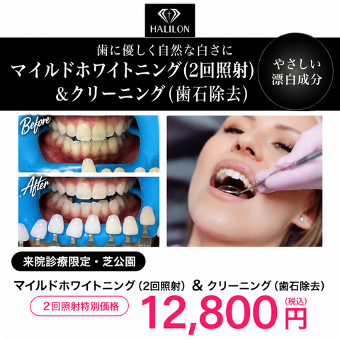 来院診療｜マイルドホワイトニングプラン(2回照射)【HALILON Oral Studio】