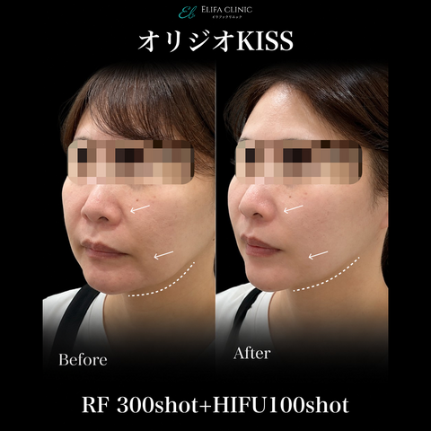 In-clinic visit | Oligio KISS (RF 300 shots + HIFU 100 shots) 【Elifa Clinic】