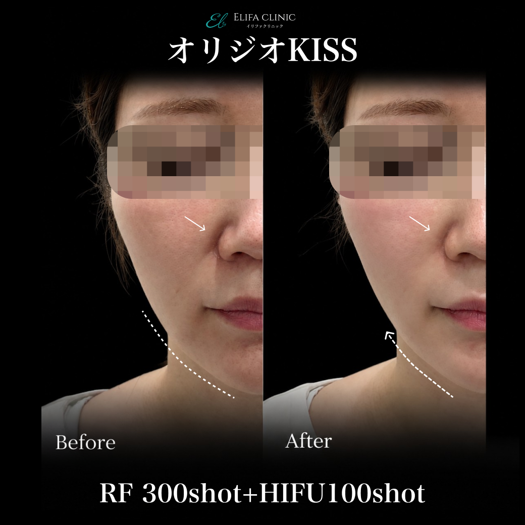 来院診療｜オリジオKISS （RF300shot+HIFU100shot）【Elifa Clinic】