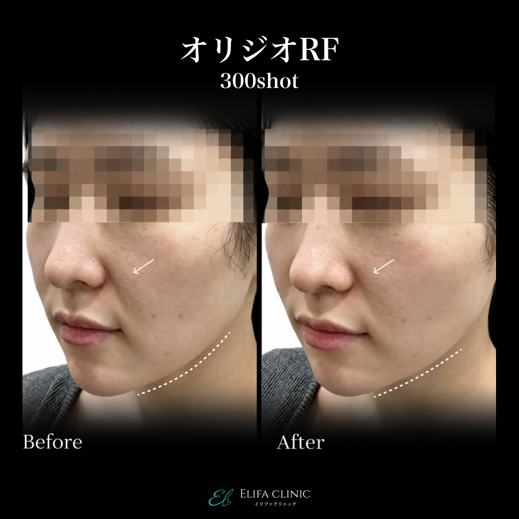 来院診療｜オリジオRF300shot 【Elifa Clinic】