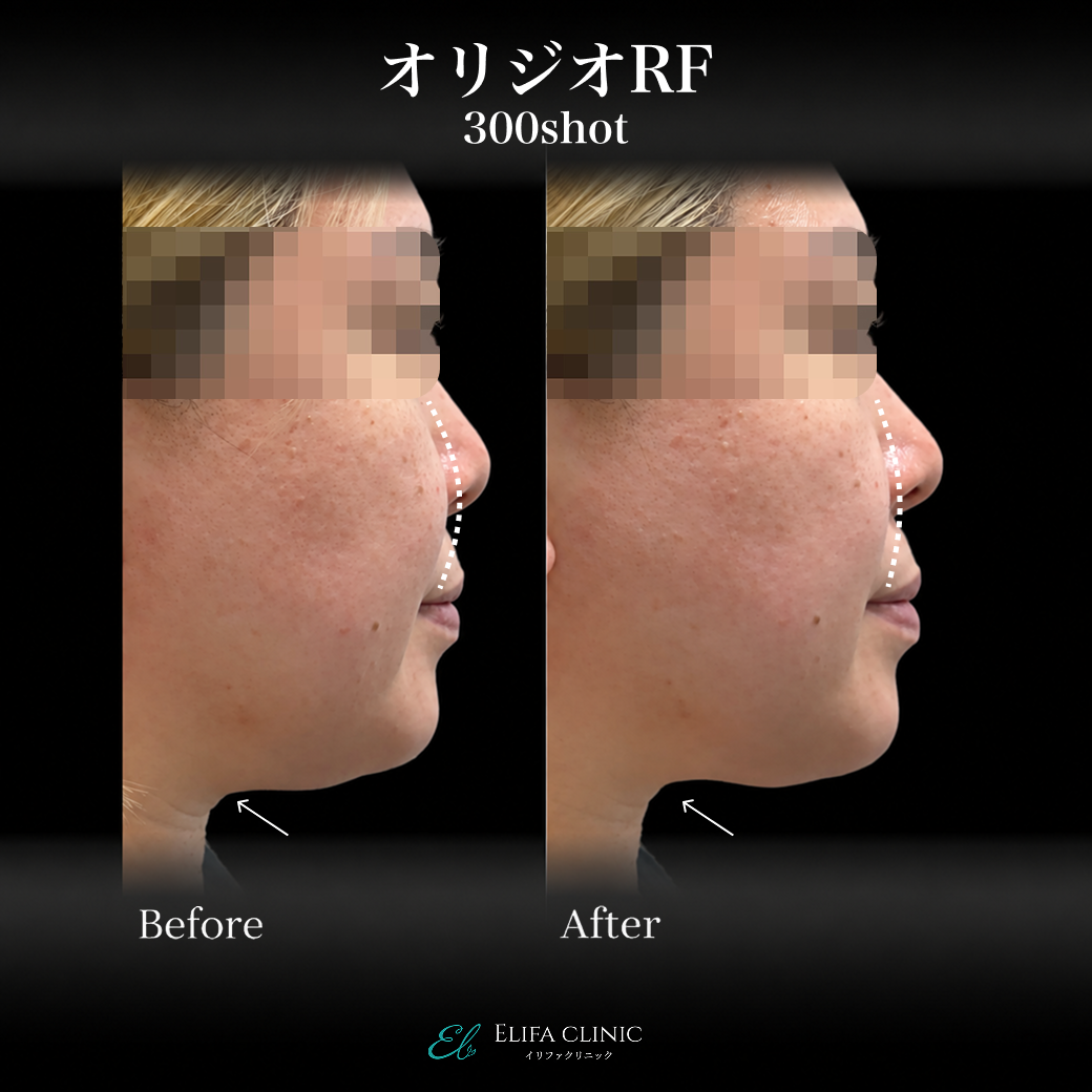 来院診療｜オリジオRF300shot 【Elifa Clinic】