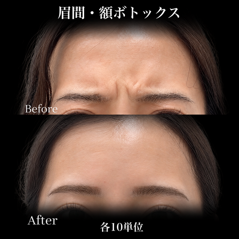 10月🎃マンスリーキャンペーン｜ボツラックス【Wellness Plus Clinic】
