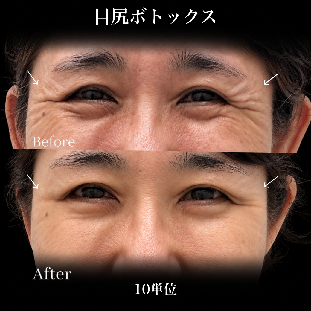 来院診療｜ボツラックス10U/50U/100U/200U【Elifa Clinic】
