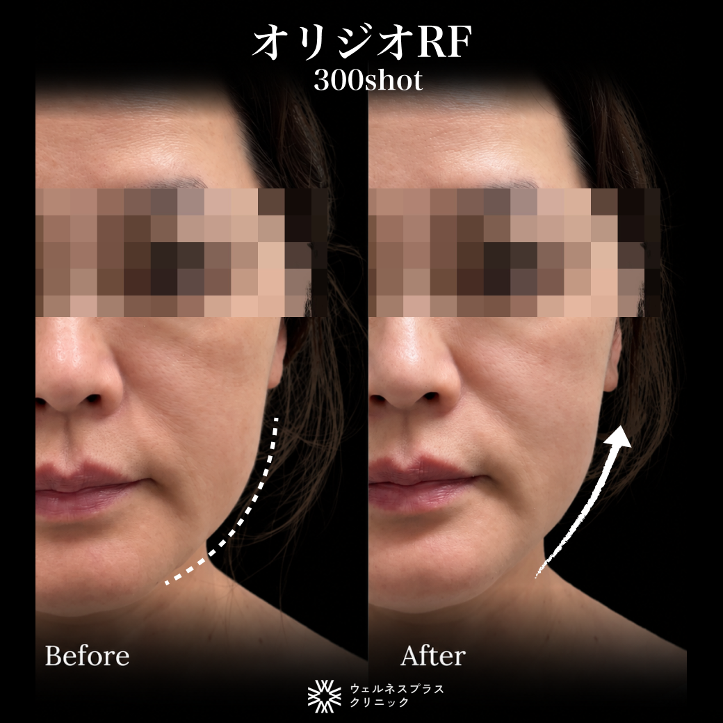 In-clinic visit | Oligio RF 300 shots 【Wellness Plus Clinic】