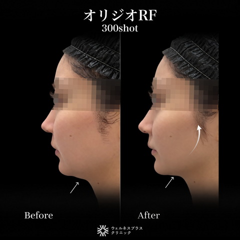 In-clinic visit | Oligio RF 300 shots 【Wellness Plus Clinic】
