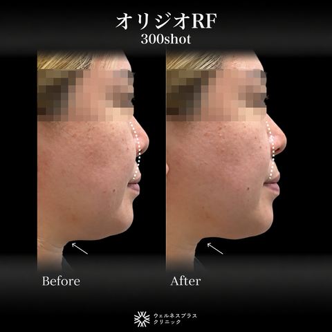 来院診療｜オリジオRF300shot 【Wellness Plus Clinic】