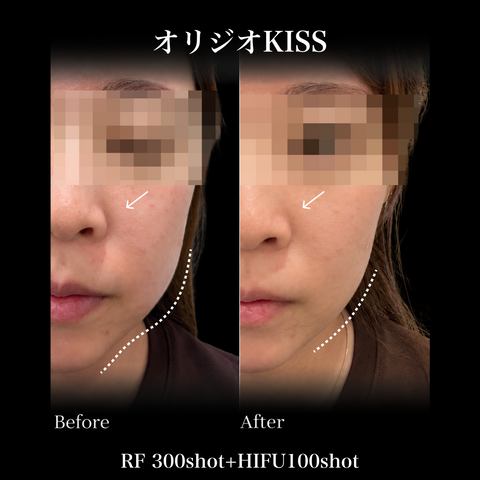 来院診療｜オリジオKISS（RF300shot+HIFU100shot）【Wellness Plus Clinic】