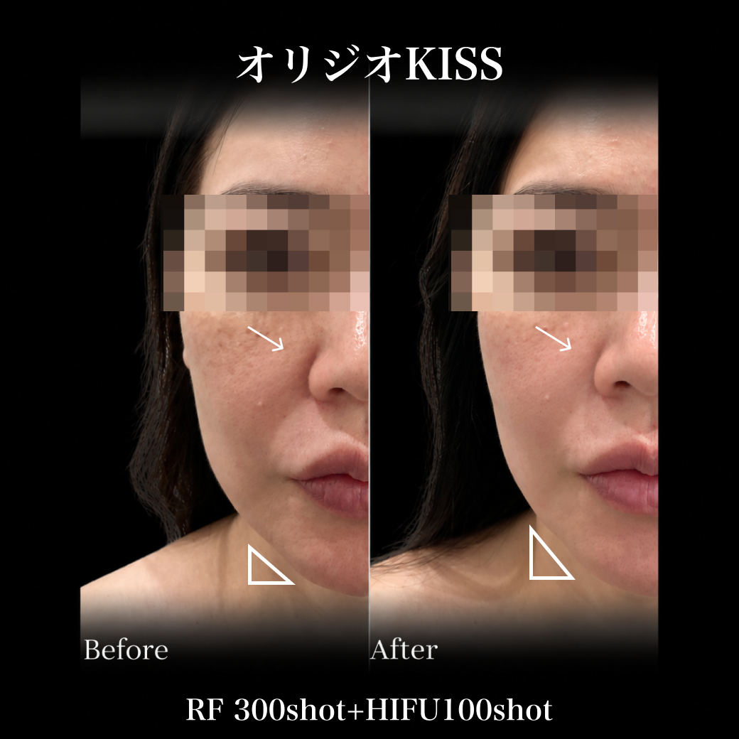 来院診療｜オリジオKISS（RF300shot+HIFU100shot）【Wellness Plus Clinic】
