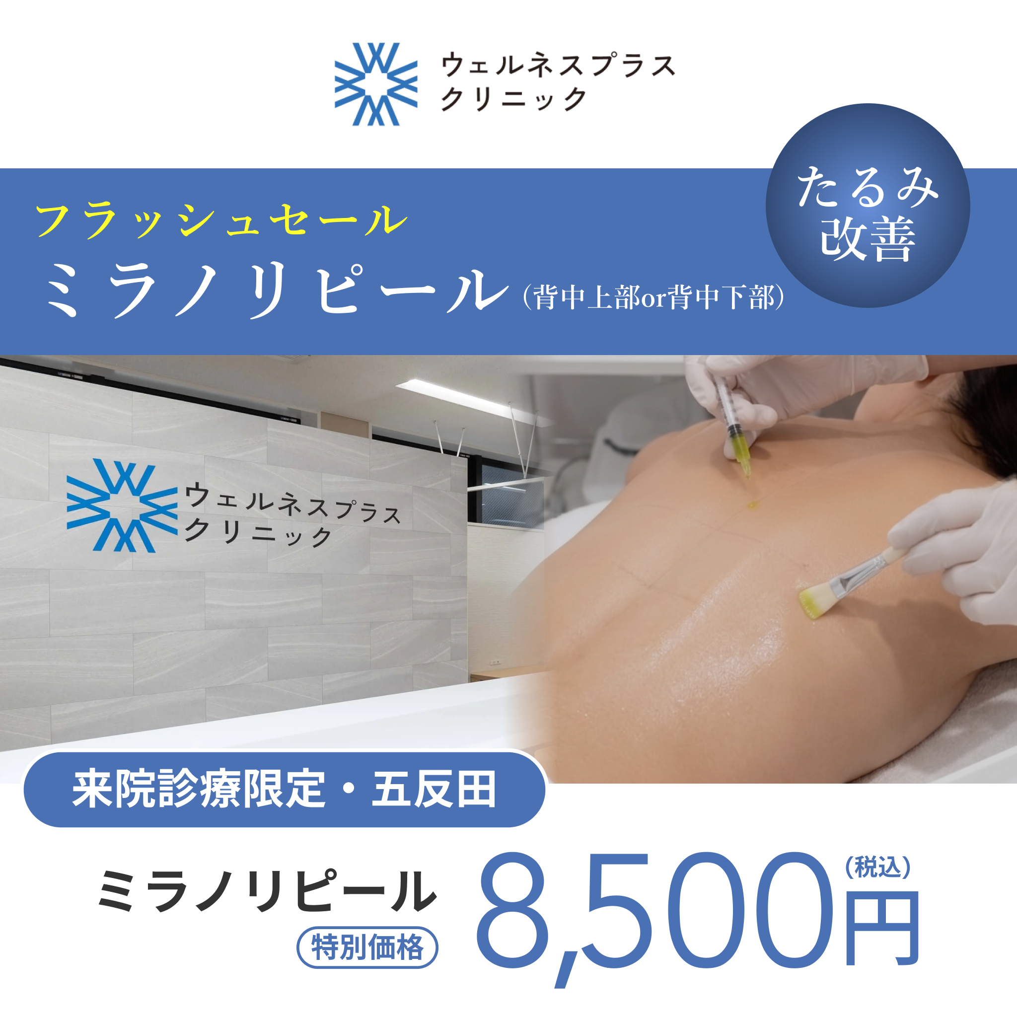 フラッシュキャンペーン｜ミラノリピール（背中上部or下部）【Wellness Plus Clinic】