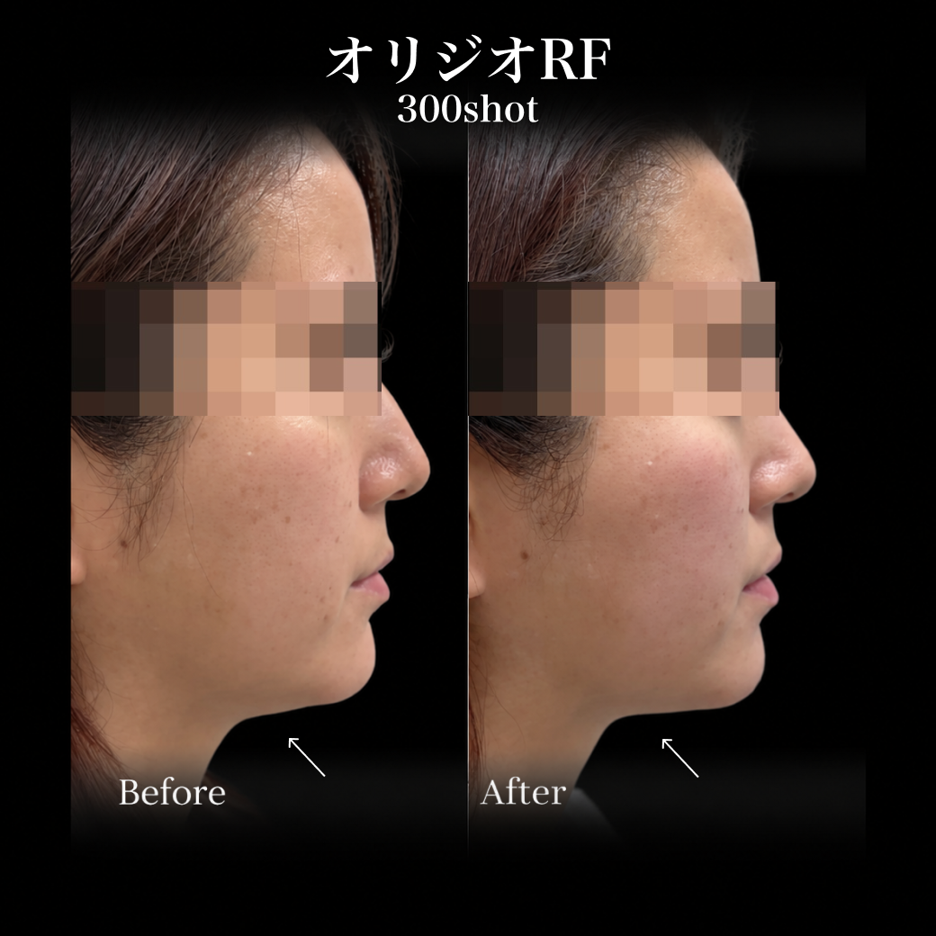 来院診療｜オリジオRF300shot 【Elifa Clinic】