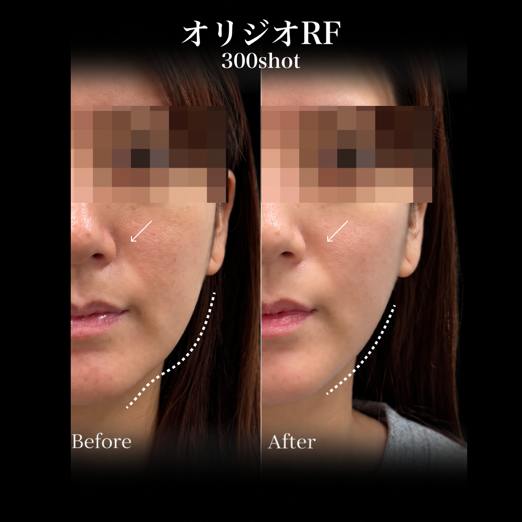 来院診療｜オリジオRF300shot 【Elifa Clinic】