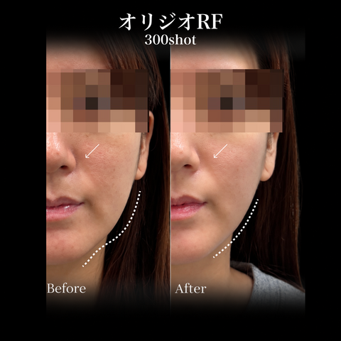 来院診療｜オリジオRF300shot 【Elifa Clinic】